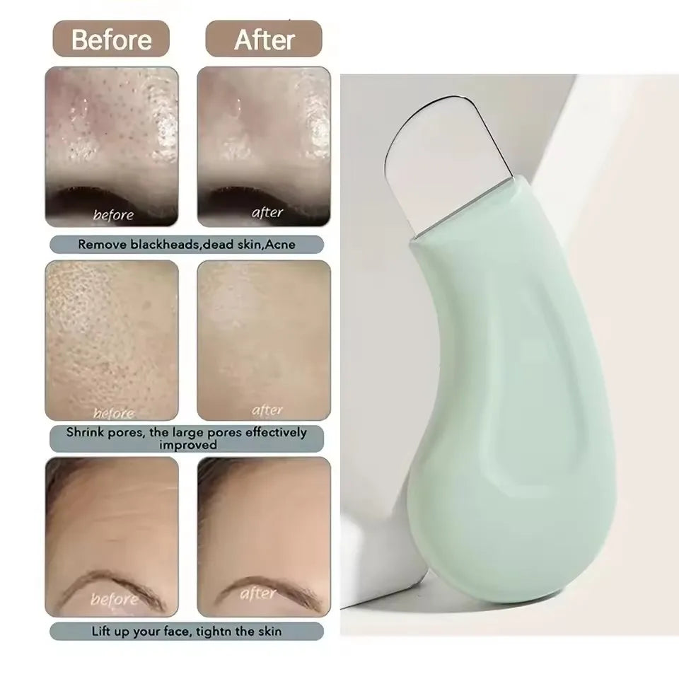 Blackhead and Whitehead Removal Tool for Nose & Face Care