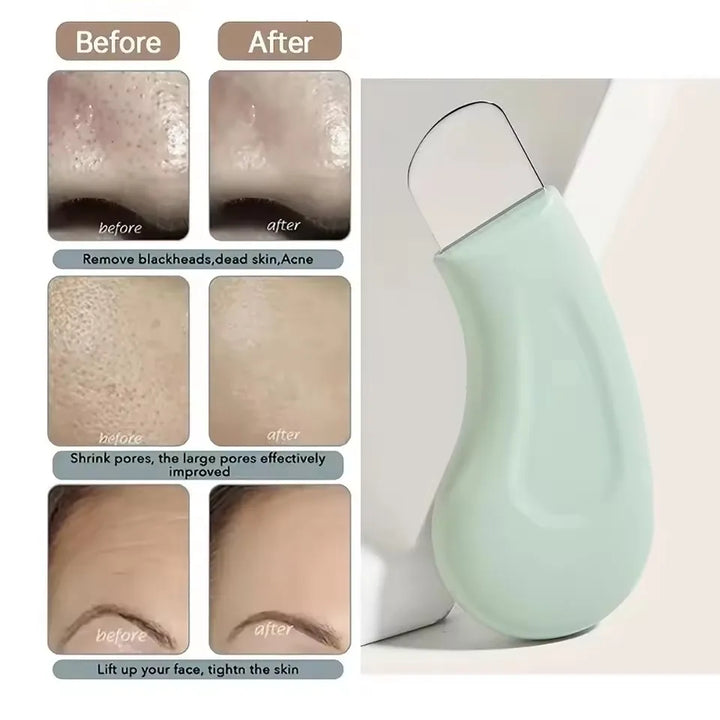 Blackhead and Whitehead Removal Tool for Nose & Face Care